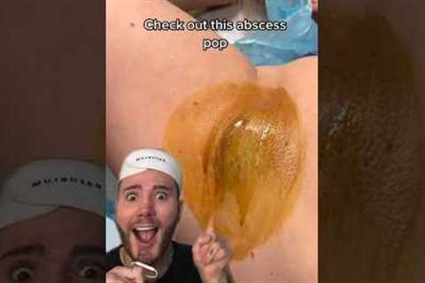 HUGE PIMPLE POP!😱 (follow for more!💗) #acne #acnetreatment #skincare #skincareroutine #acneremoval