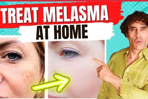 How to Treat MELASMA - Treat DARK SPOTS & PATCHES on The SKIN