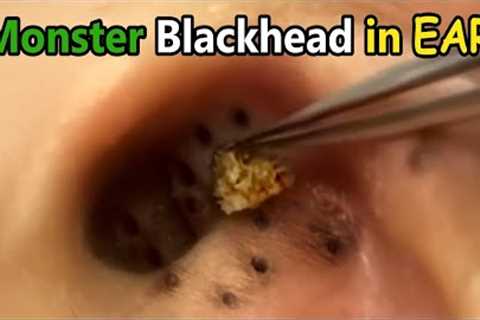 Monster Blackhead in Ear