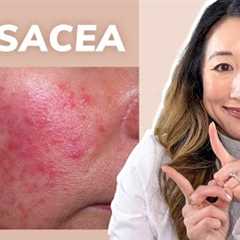 Dermatologist Guide to ROSACEA - Treatments & Skincare Products